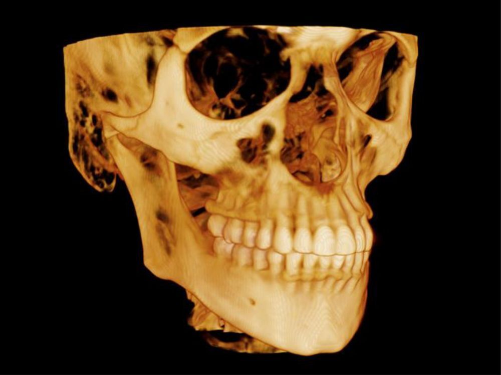 顎関節部3D画像